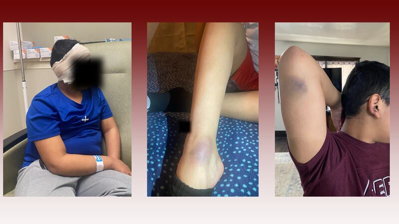 A fifth grade student at Sam Rayburn Intermediate School shows injuries he received after...