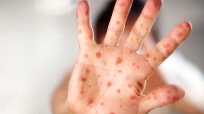 West Texas A&M University has been notified of a confirmed case of measles exposure involving...