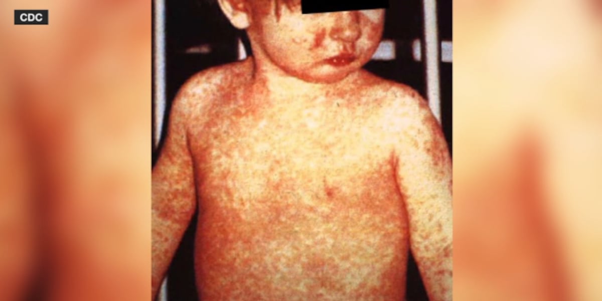 Second unvaccinated child in same household contracts measles: Waco-McLennan County health district